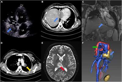 Case report: Right atrium-inferior vena cava bypass in a patient with unusual cardiac cystic echinococcosis